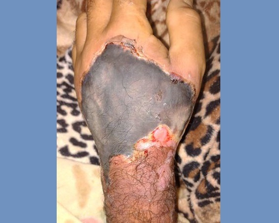 “Se le está pudriendo la mano a mi papá”: denunciaron negligencia y abandono de persona en clínica obereña