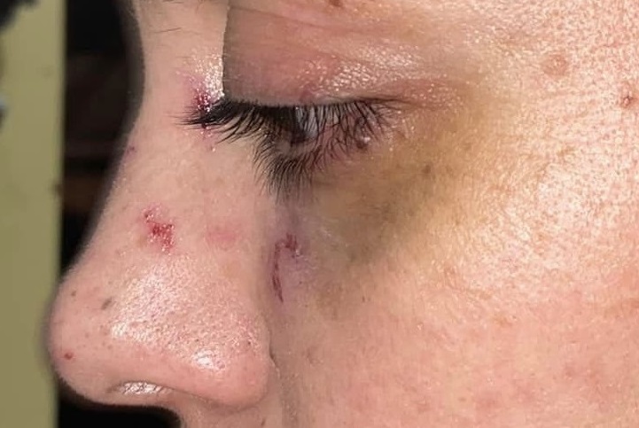 El infierno de una víctima de violencia de género y la impunidad del agresor que escapó al Brasil