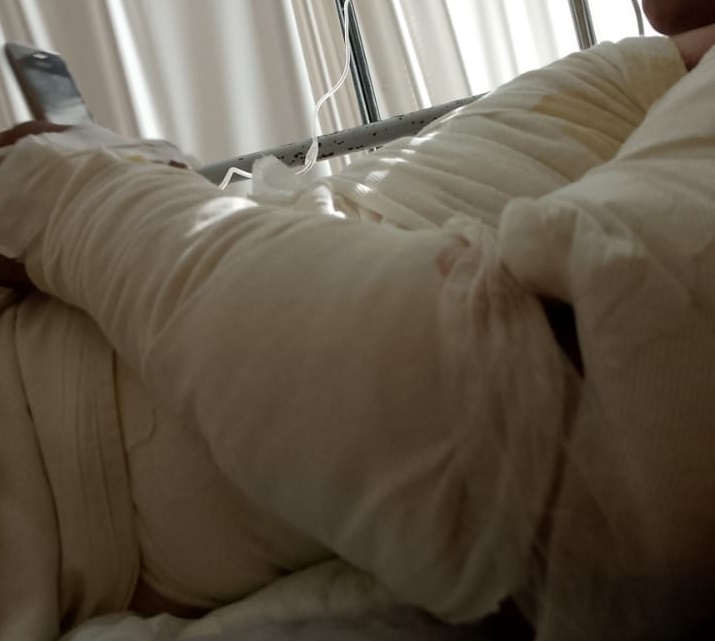 Operaron al menor que padeció una descarga eléctrica: tiene el 60% del cuerpo quemado