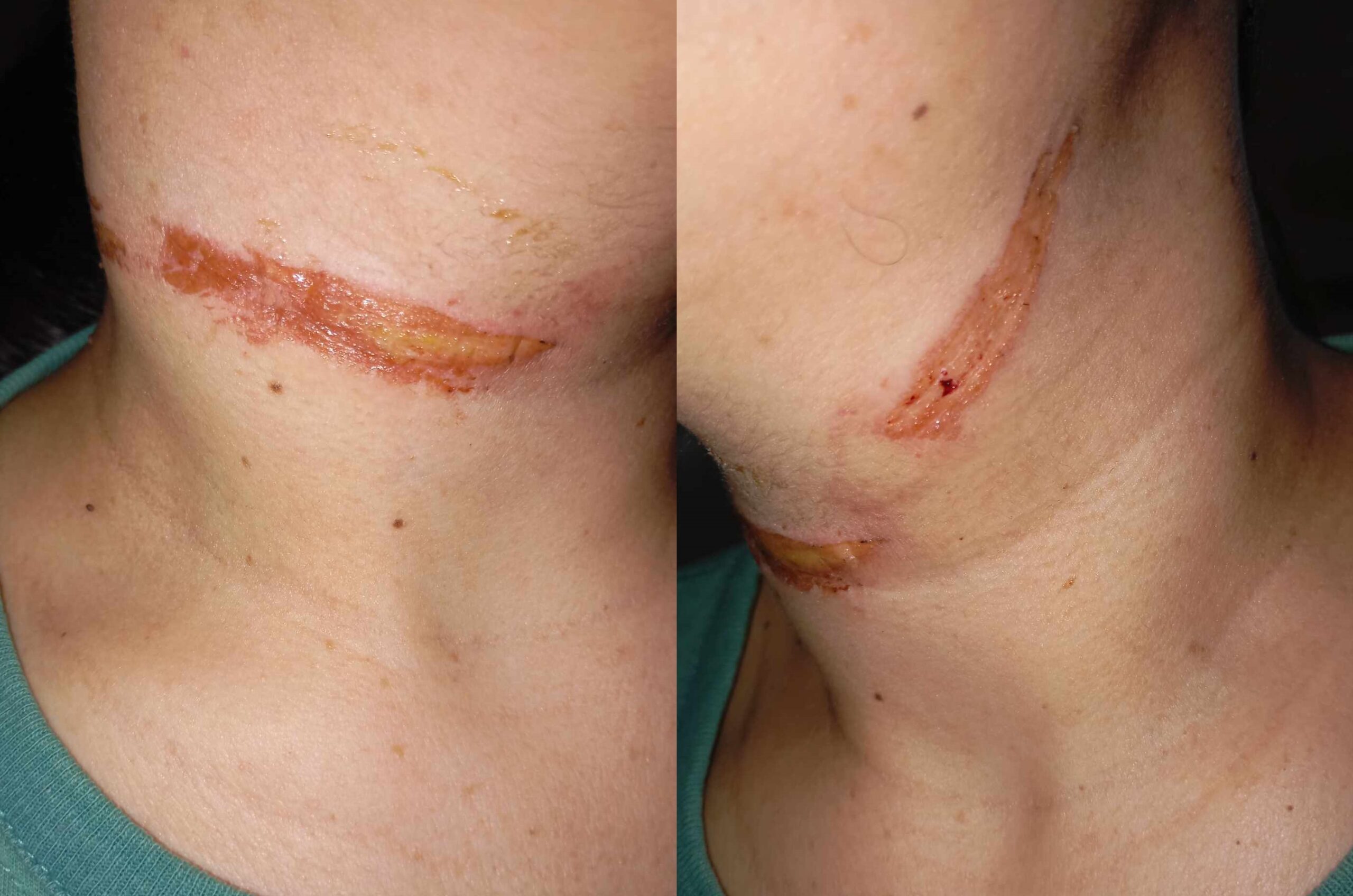 Secuelas de una irresponsabilidad: un cable caído casi se cobra una vida en Oberá