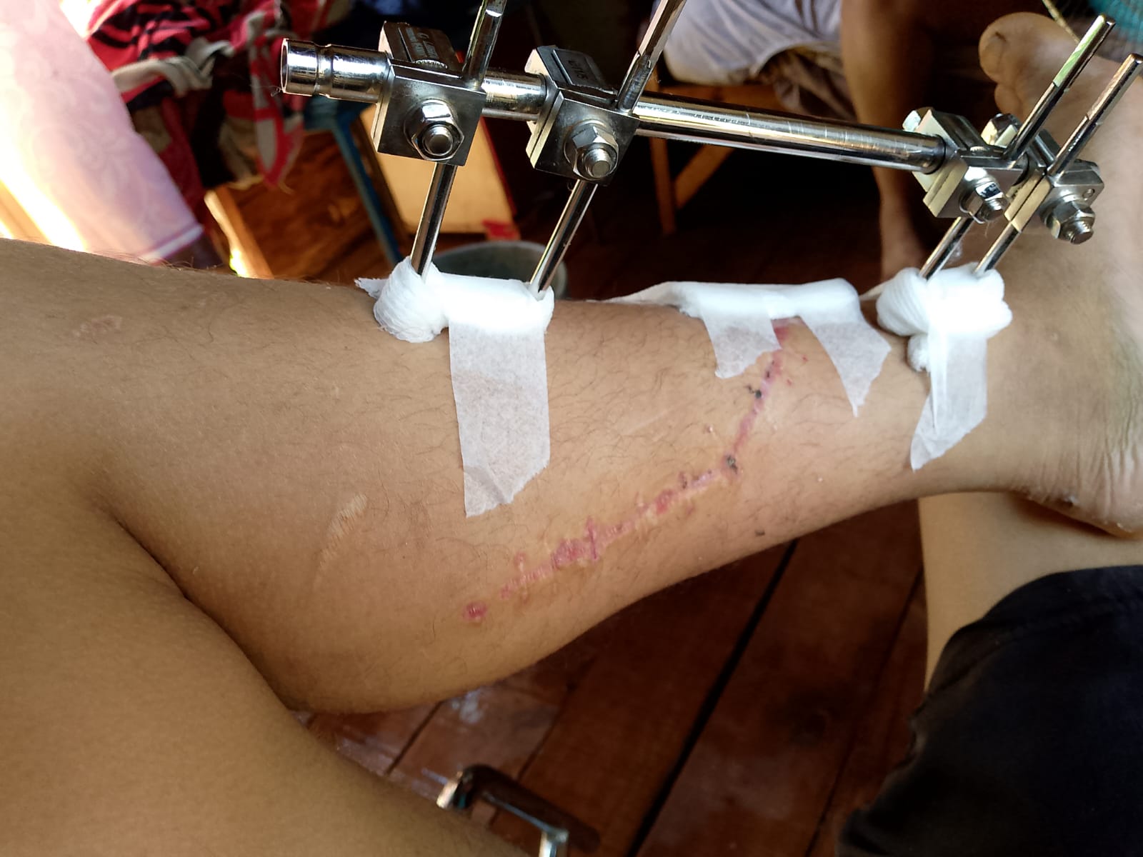 Sufrió un grave accidente laboral y requiere asistencia para afrontar el día a día