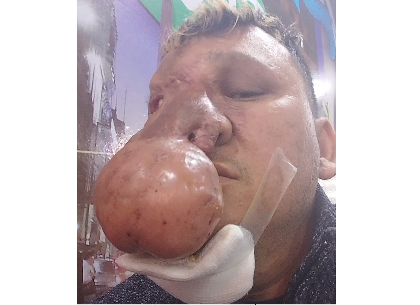 Luis fue asistido en Buenos Aires y se enfoca en una futura cirugía para tratar su tumor facial