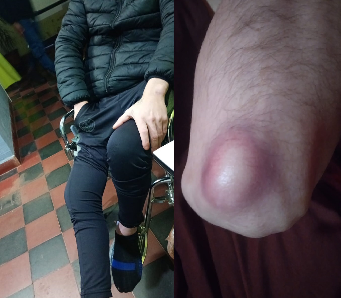 Brutalidad policial: un hombre que no puede caminar denunció por abuso y lesiones al jefe de Infantería de Acaragúa