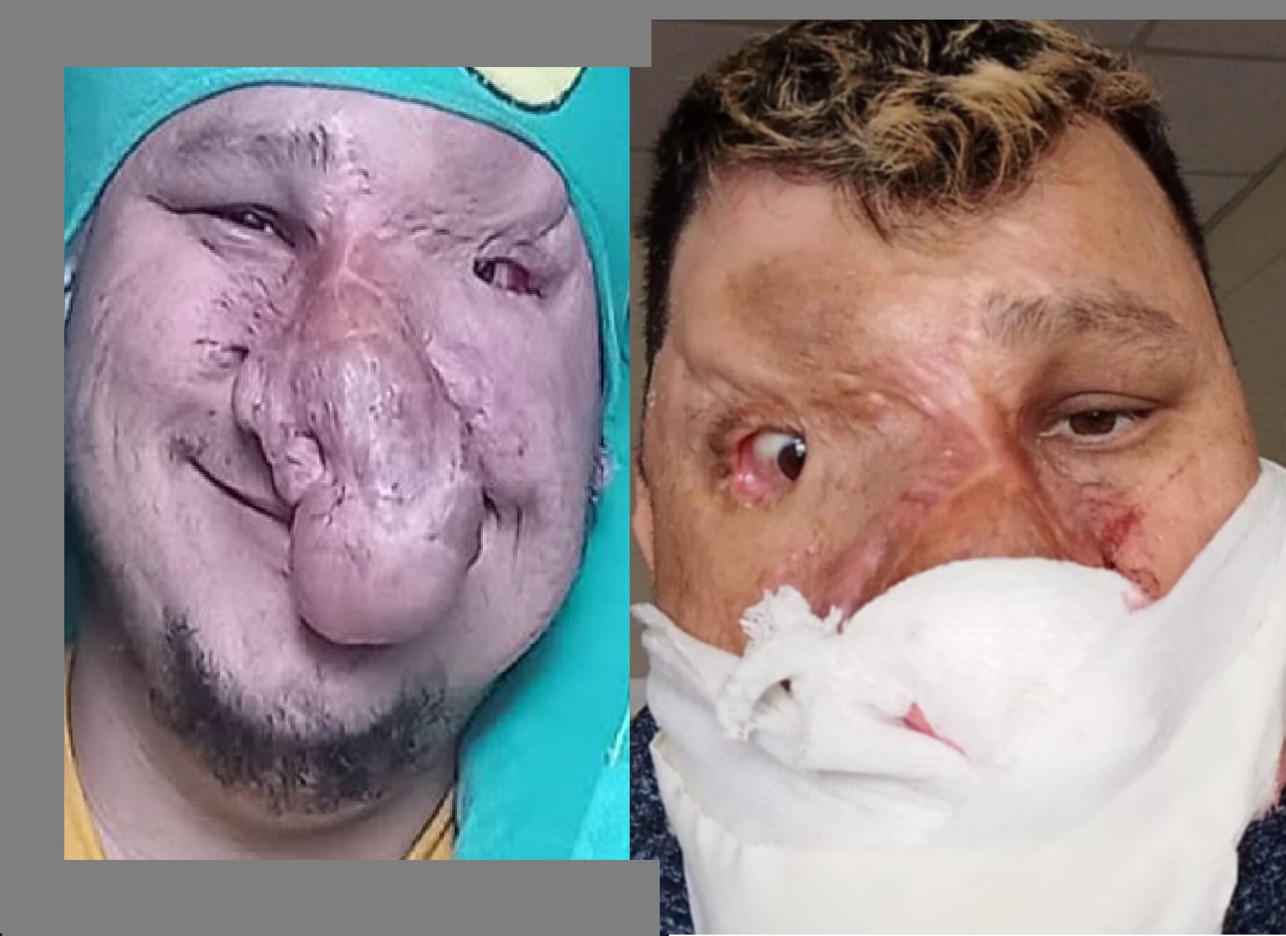 Pedido solidario para un obereño con un tumor en la nariz y hemorragias: viaja a Buenos Aires por atención