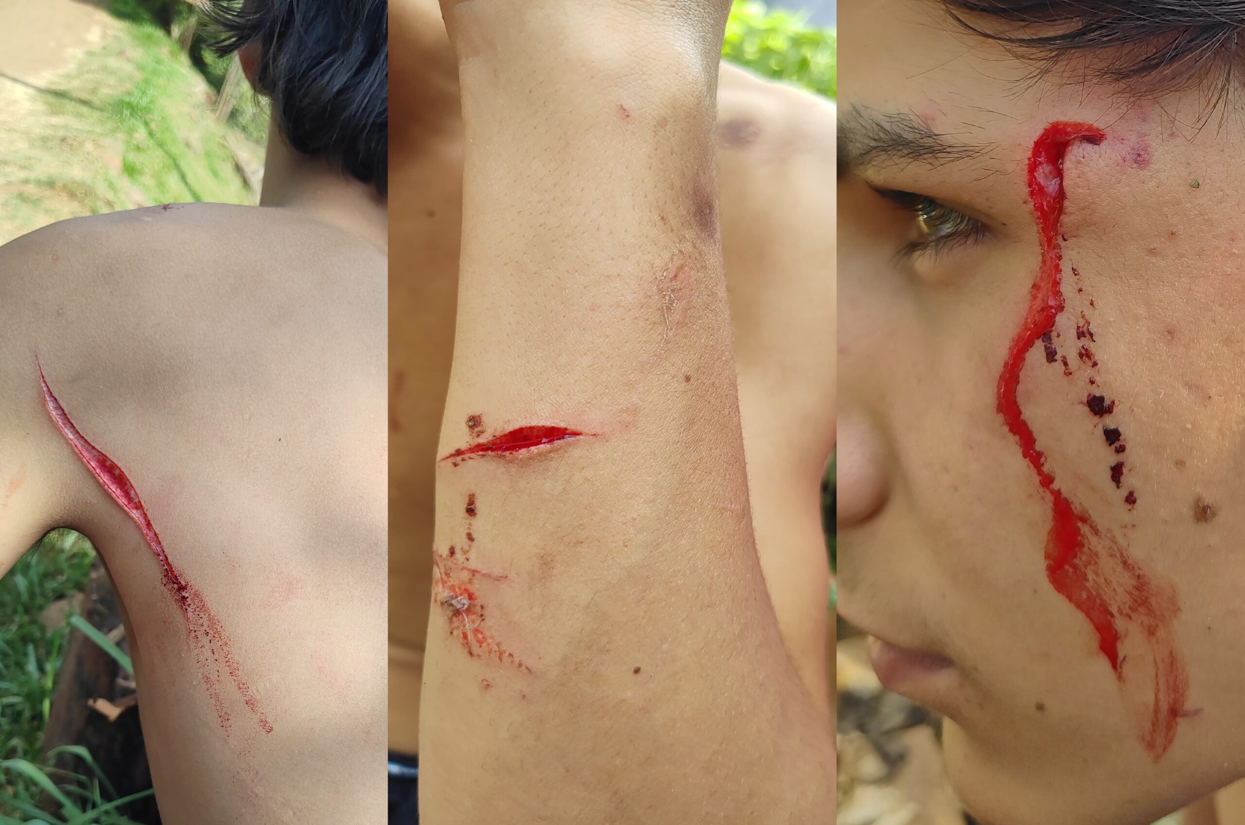 Menor de 15 años fue atacado a machetazos por un vecino en barrio Villa Blanquita