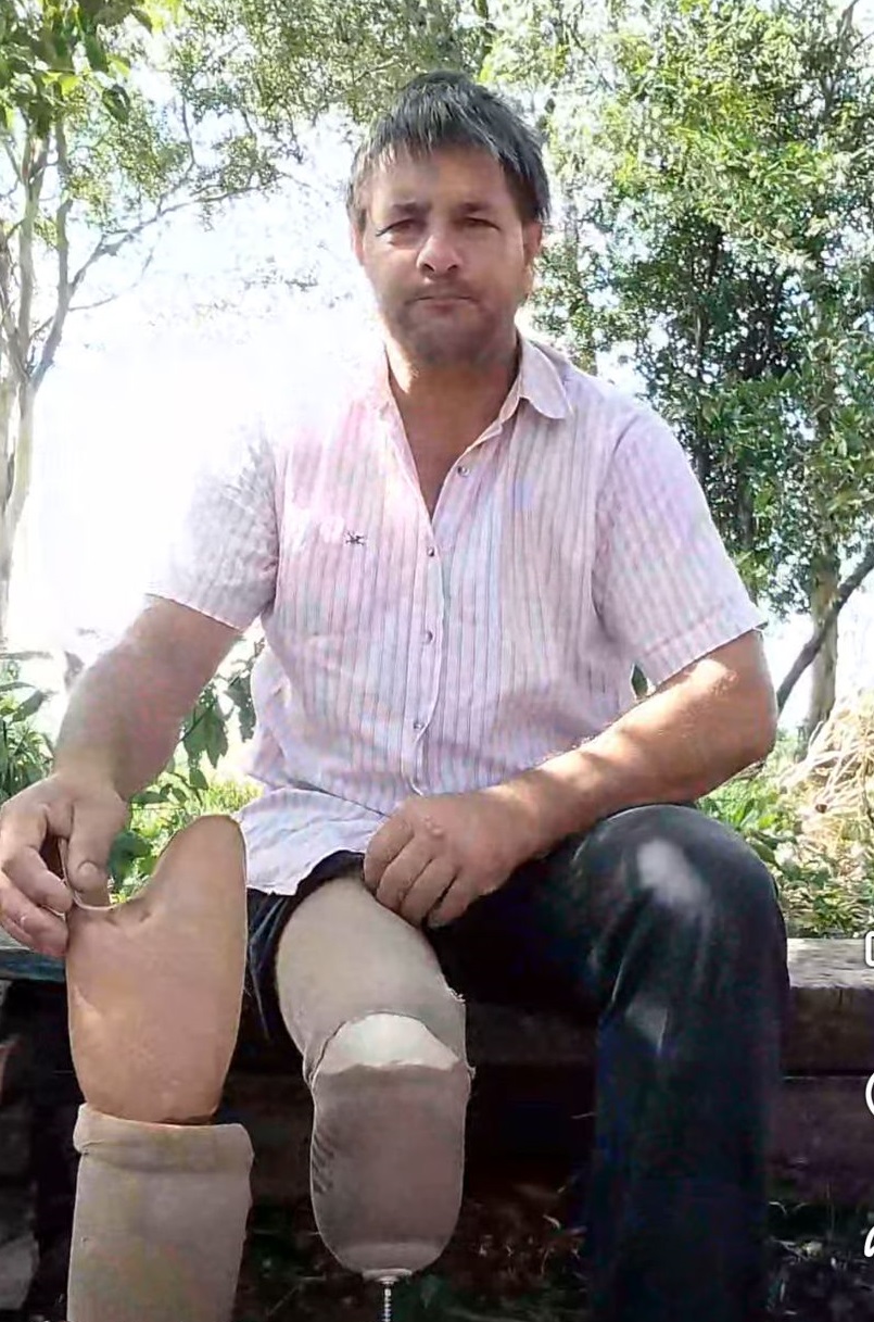 Perdió una pierna, cría a su hijo y necesita de la solidaridad para mejorar su prótesis: de Campo Viera